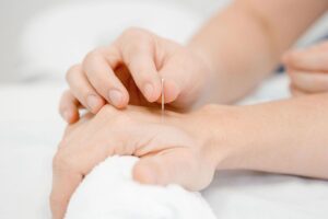 acupuncture needle treatment in a hand